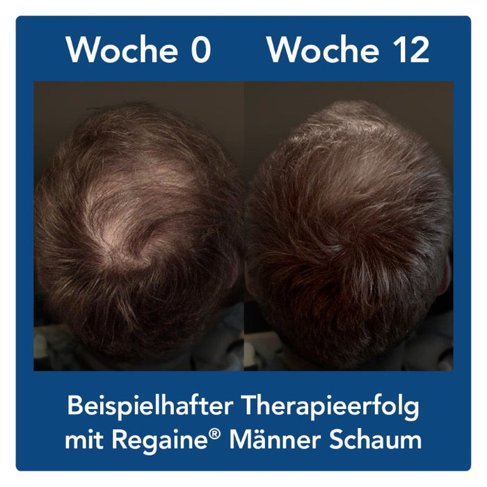 Regaine Männer Schaum, 180 ml Schaum